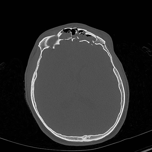 Base of skull fracture with bilateral Le Fort fractures (Radiopaedia 47094-51638 Axial bone window 53).jpg