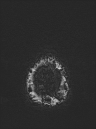 Basilar artery perforator aneurysm (Radiopaedia 82455-97733 Axial SWI 64).jpg