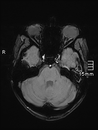 File:Basilar artery perforator aneurysm (Radiopaedia 82455-99523 Axial SWI 18).jpg