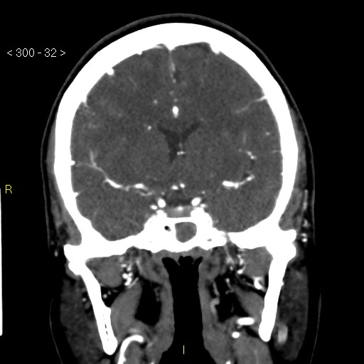 File:Basilar artery thrombosis (Radiopaedia 16260-15944 B 23).jpg
