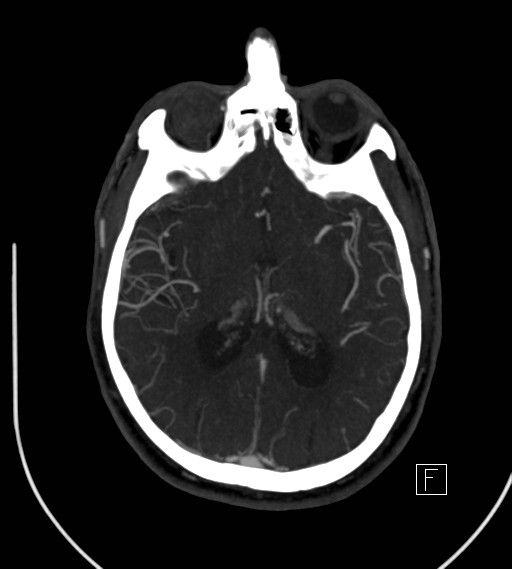 Basilar artery thrombosis (Radiopaedia 26986-27163 A 48).jpg