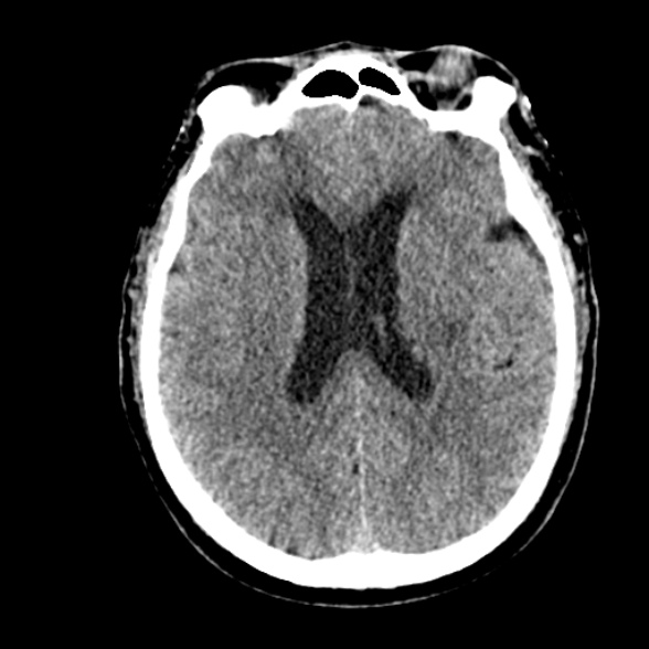 File:Basilar artery thrombosis (Radiopaedia 53351-59352 Axial non-contrast 71).jpg