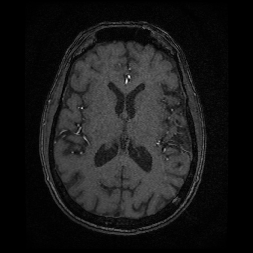 Basilar top and left middle cerebral artery aneurysm (Radiopaedia 61965-70031 Axial MRA 95).jpg