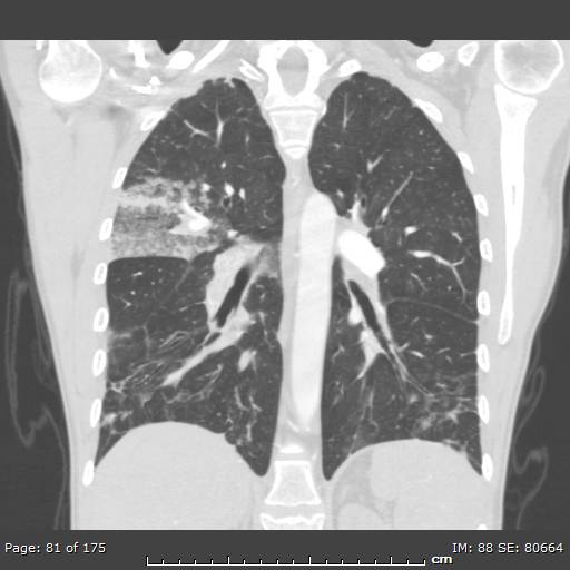 File:Behçet disease (Radiopaedia 44247-47889 Coronal lung window 23).jpg