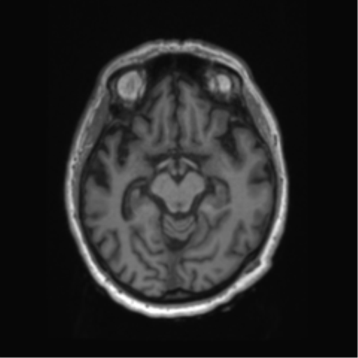 Behavioral variant frontotemporal dementia and late onset schizophrenia (Radiopaedia 52197-58083 Axial T1 63).png