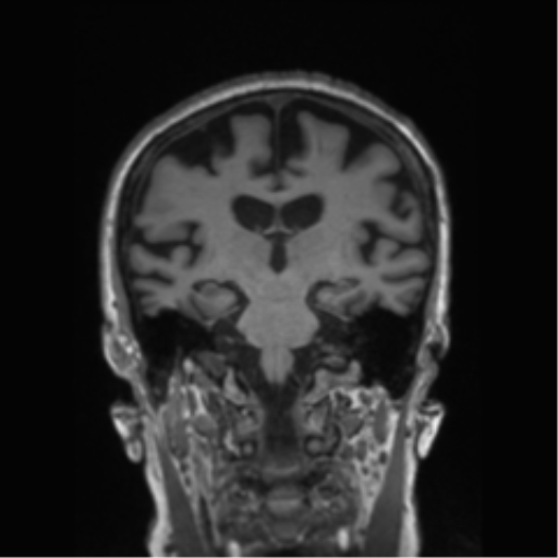 Behavioral variant frontotemporal dementia and late onset schizophrenia (Radiopaedia 52197-58083 Coronal T1 45).png