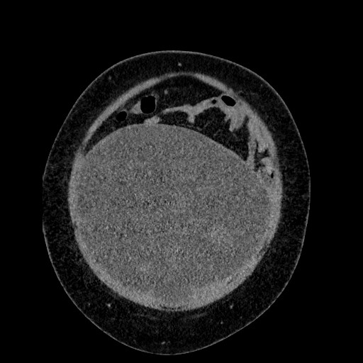 File:Benign leiomyoma with hydropic features (Radiopaedia 89250-106130 B 24).jpg