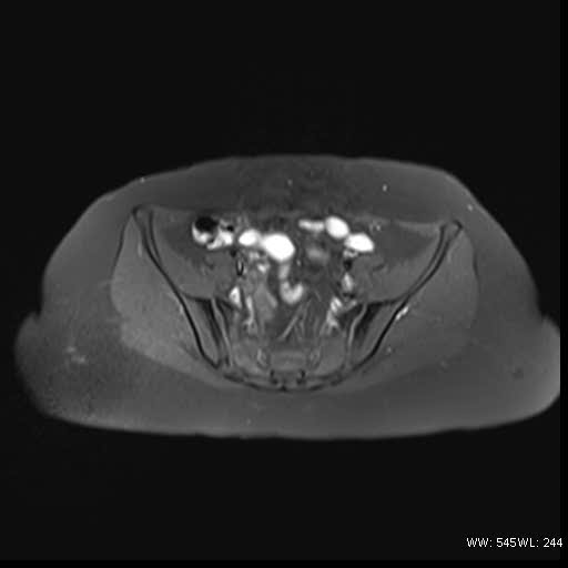 File:Bicornuate uterus- on MRI (Radiopaedia 49206-54297 Axial T1 fat sat 6).jpg