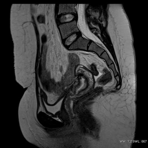 File:Bicornuate uterus- on MRI (Radiopaedia 49206-54297 Sagittal T2 14).jpg