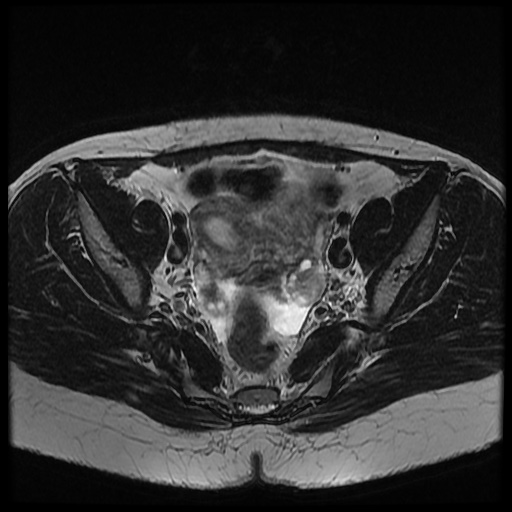 File:Bicornuate uterus (Radiopaedia 51676-57472 Axial T2 21).jpg