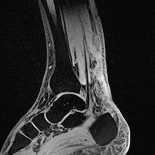Bilateral Achilles tendon complete tear (Radiopaedia 81344-95051 Sagittal WE - Left 49).jpg