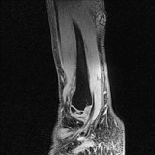 File:Bilateral Achilles tendon complete tear (Radiopaedia 81344-95051 Sagittal WE - Right 24).jpg
