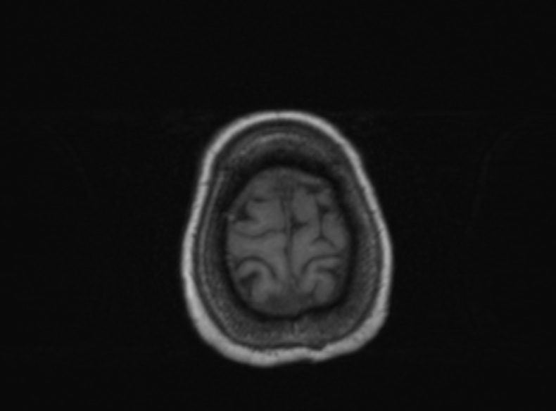 File:Bilateral PCA territory infarction - different ages (Radiopaedia 46200-51784 Axial T1 126).jpg
