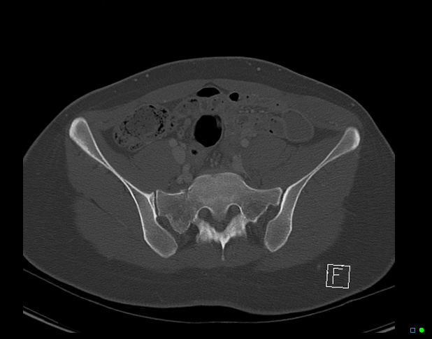 File:Bilateral acetabular fractures (Radiopaedia 79272-92308 Axial bone window 18).jpg