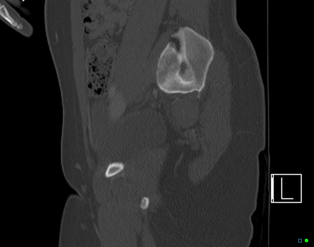 Bilateral acetabular fractures (Radiopaedia 79272-92308 Sagittal bone window 31).jpg