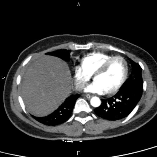 Bilateral adrenal gland hyperenhancement in pancreatitis (Radiopaedia 86642-102753 B 7).jpg
