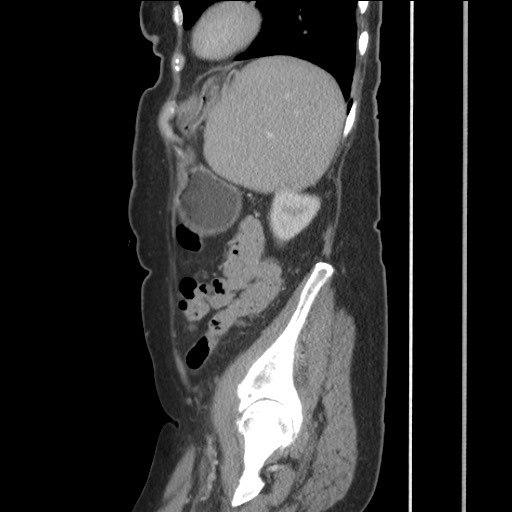 Bilateral adrenal granulocytic sarcomas (chloromas) (Radiopaedia 78375-91007 C 107).jpg