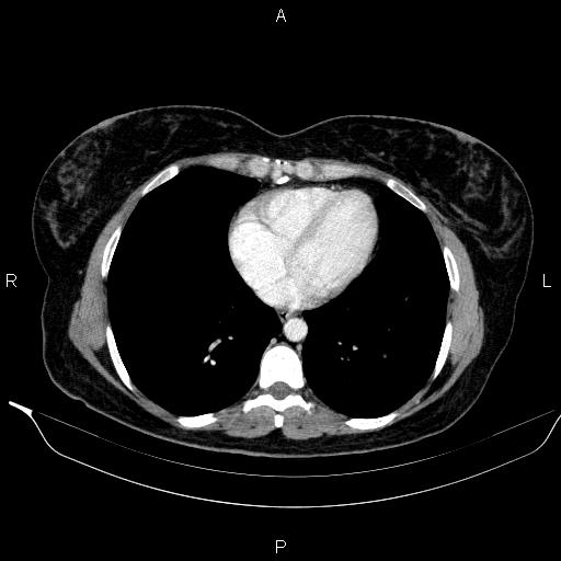 File:Bilateral adrenal myelolipoma (Radiopaedia 63058-71535 B 1).jpg