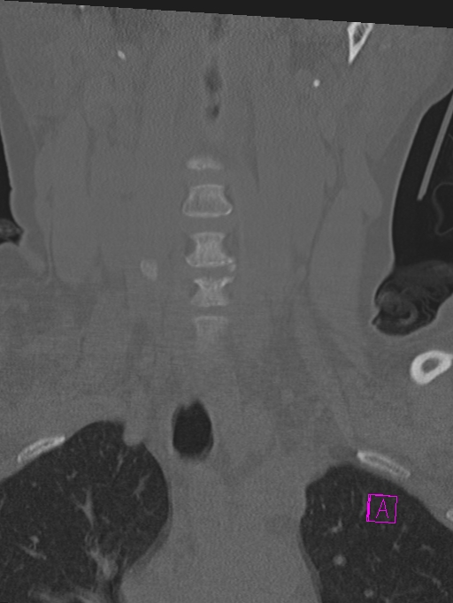Bilateral atlanto-occipital assimilation (Radiopaedia 28350-28603 Coronal bone window 7).jpg