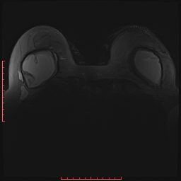 File:Bilateral breast implant rupture (Radiopaedia 24761-25027 PASTA Si 23).jpg
