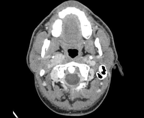 Bilateral carotid body tumors (Radiopaedia 61841-69870 Axial Post contrast 20).jpg