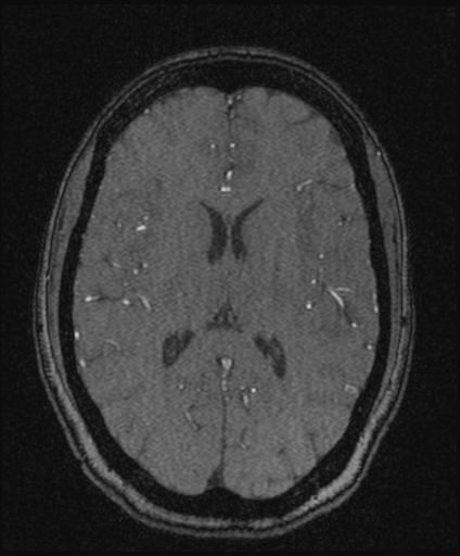 Bilateral carotid body tumors and right glomus jugulare tumor (Radiopaedia 20024-20060 Axial MRA 107).jpg