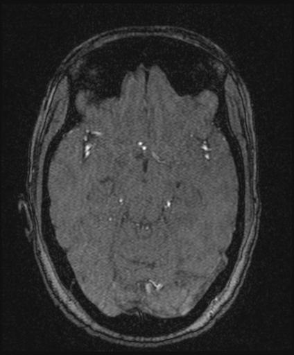 Bilateral carotid body tumors and right glomus jugulare tumor (Radiopaedia 20024-20060 Axial MRA 76).jpg