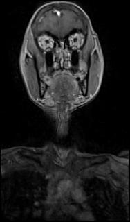 File:Bilateral carotid body tumors and right glomus jugulare tumor (Radiopaedia 20024-20060 MRA 3).jpg