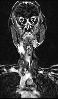 File:Bilateral carotid body tumors and right glomus jugulare tumor (Radiopaedia 20024-20060 MRA 81).jpg