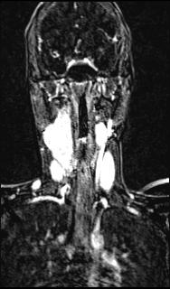 Bilateral carotid body tumors and right glomus jugulare tumor (Radiopaedia 20024-20060 MRA 96).jpg