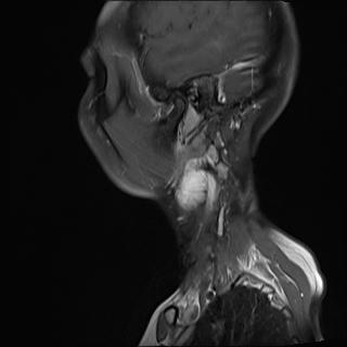 File:Bilateral carotid body tumors and right jugular paraganglioma (Radiopaedia 20024-20060 Sagittal 7).jpg