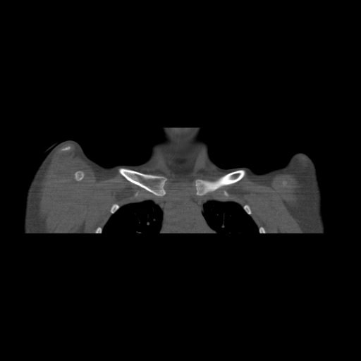 Bilateral chronic posterior shoulder dislocation (Radiopaedia 39213-41452 Coronal bone window 9).jpg