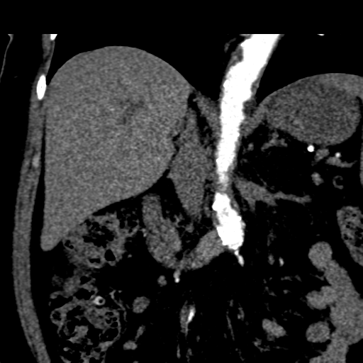 File:Bilateral delayed nephrogram from renal artery stenosis (Radiopaedia 47681-52362 C 3).png