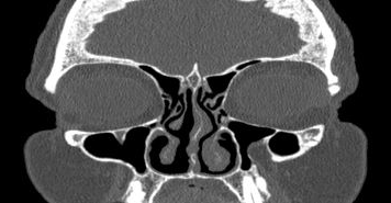 File:Bilateral ectopic infraorbital nerves (Radiopaedia 49006-54084 Coronal 51).png