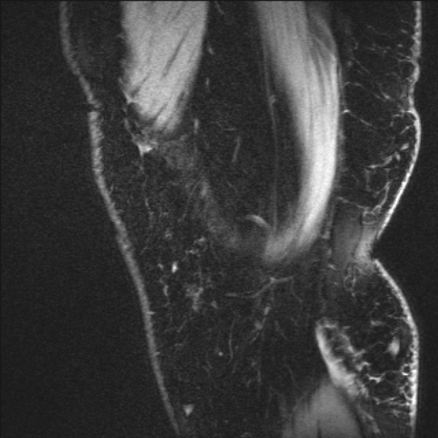 Bilateral focal pigmented villonodular synovitis (Radiopaedia 67643-77073 Sagittal T1 vibe 62).jpg