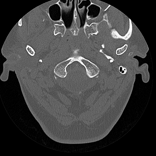 File:Bilateral ossifications of the external auditory canal (Radiopaedia 15233-15076 Axial bone window 26).jpg