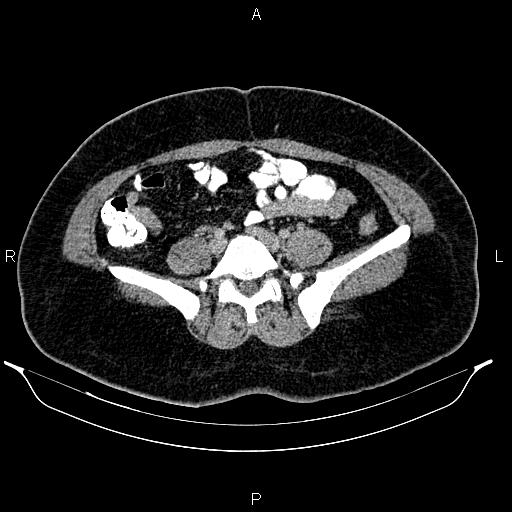 Bilateral ovarian dermoid cysts (Radiopaedia 85785-101603 A 73).jpg