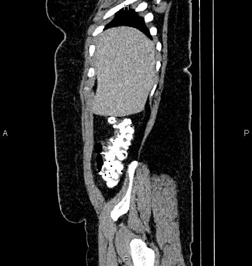 Bilateral ovarian dermoid cysts (Radiopaedia 85785-101603 D 8).jpg