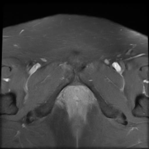 File:Bilateral ovarian dermoid cysts (Radiopaedia 90152-107338 Axial T1 C+ fat sat 22).jpg