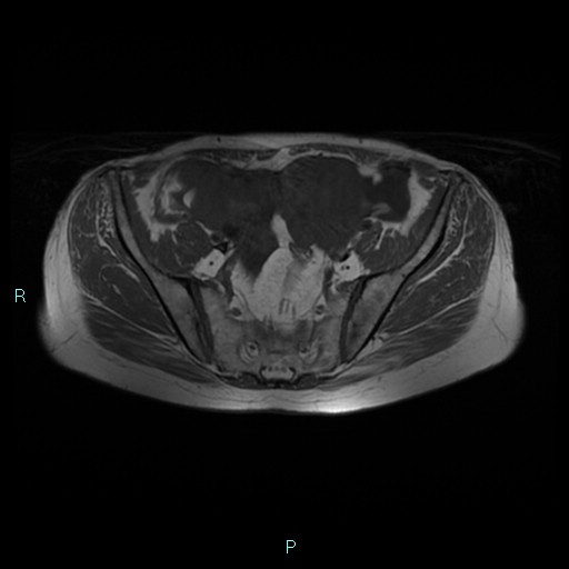 File:Bilateral ovarian fibroma (Radiopaedia 44568-48293 Axial T1 9).jpg