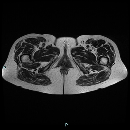 File:Bilateral ovarian fibroma (Radiopaedia 44568-48293 Axial T2 32).jpg