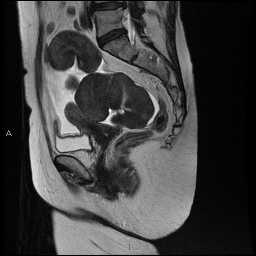File:Bilateral ovarian fibroma (Radiopaedia 44568-48293 Sagittal T2 20).jpg