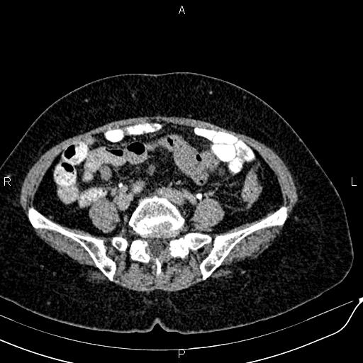 Bilateral ovarian serous cystadenocarcinoma (Radiopaedia 86062-101989 Axial C+ delayed 51).jpg