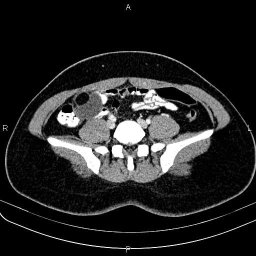 File:Bilateral ovarian teratoma (Radiopaedia 83131-97503 Axial With contrast 11).jpg