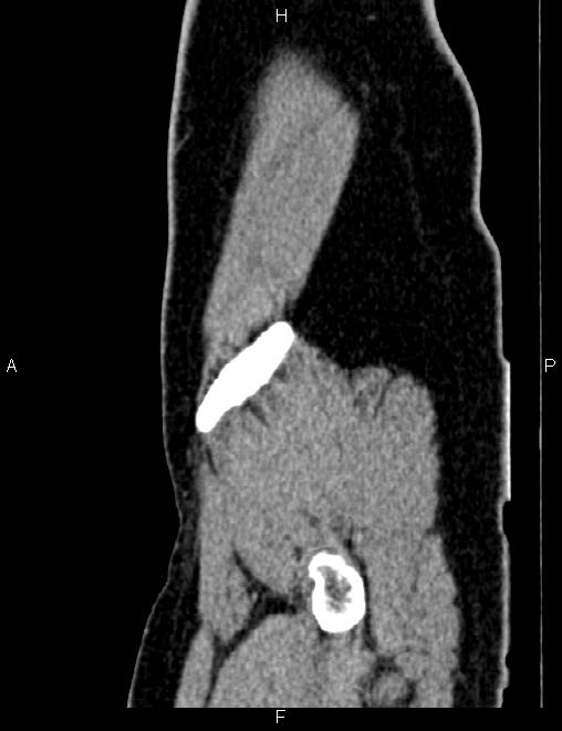 Bilateral ovarian teratoma (Radiopaedia 83131-97503 D 19).jpg