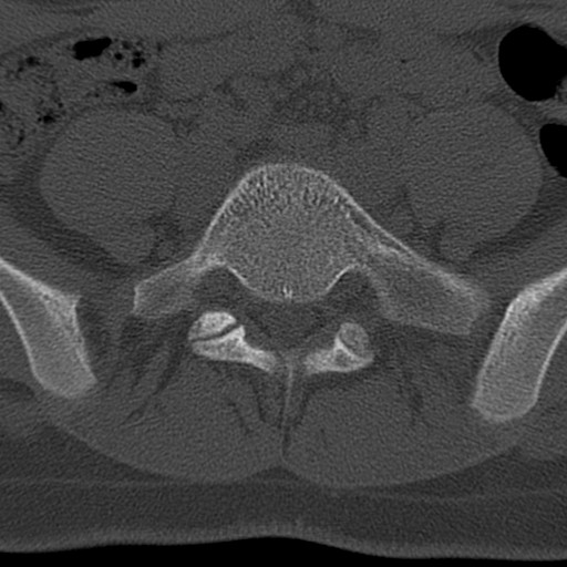 Bilateral pars defect (Radiopaedia 26691-26846 Axial bone window 61).jpg