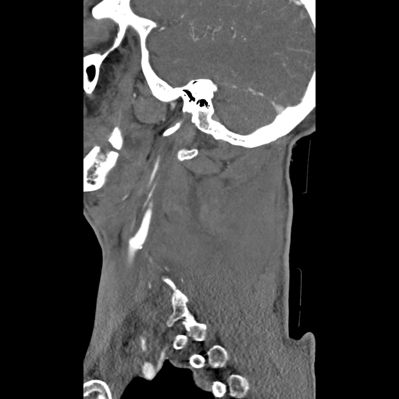 Bilateral perched facets with cord injury (Radiopaedia 45587-49713 B 43).jpg