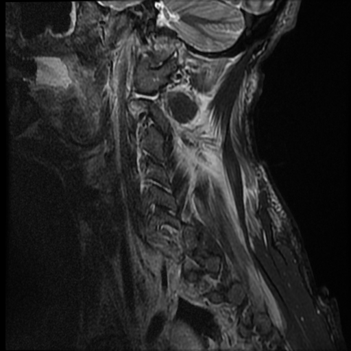 File:Bilateral perched facets with cord injury (Radiopaedia 45587-49714 Sagittal STIR 16).jpg