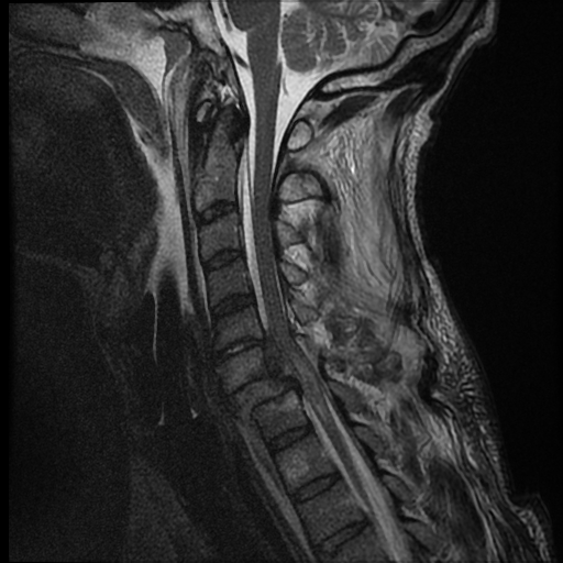 File:Bilateral perched facets with cord injury (Radiopaedia 45587-49714 Sagittal T2 8).jpg