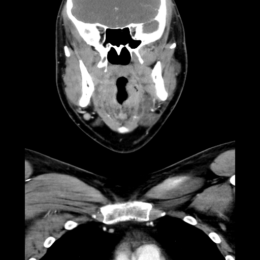 Bilateral peritonsillar abscess (Radiopaedia 85065-100610 Coronal 29).jpg